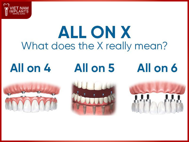 All on 6 Dental Implants Vietnam