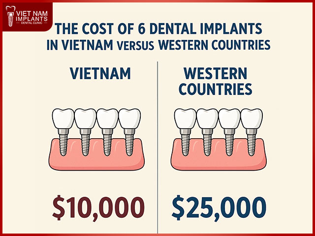 The Cost of 6 Dental Implants in Vietnam Versus Western Countries