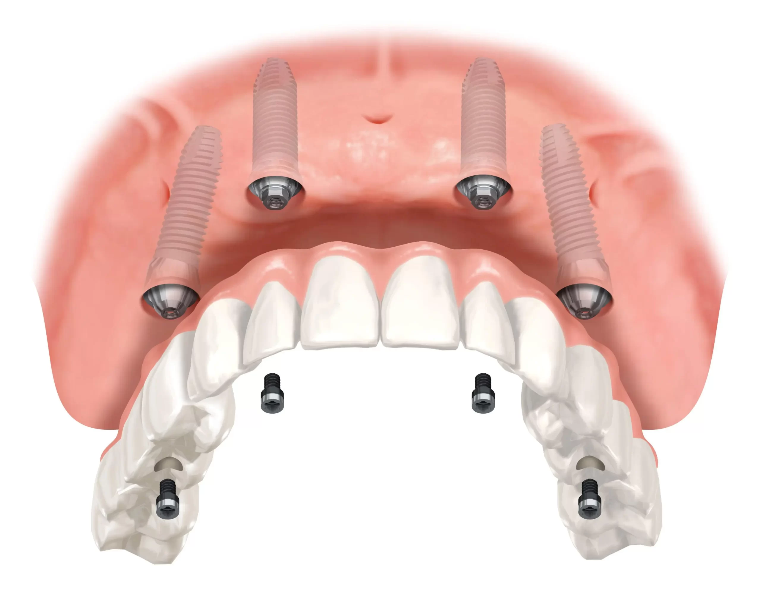 all on four implant denver scaled all on four implant denver scaled