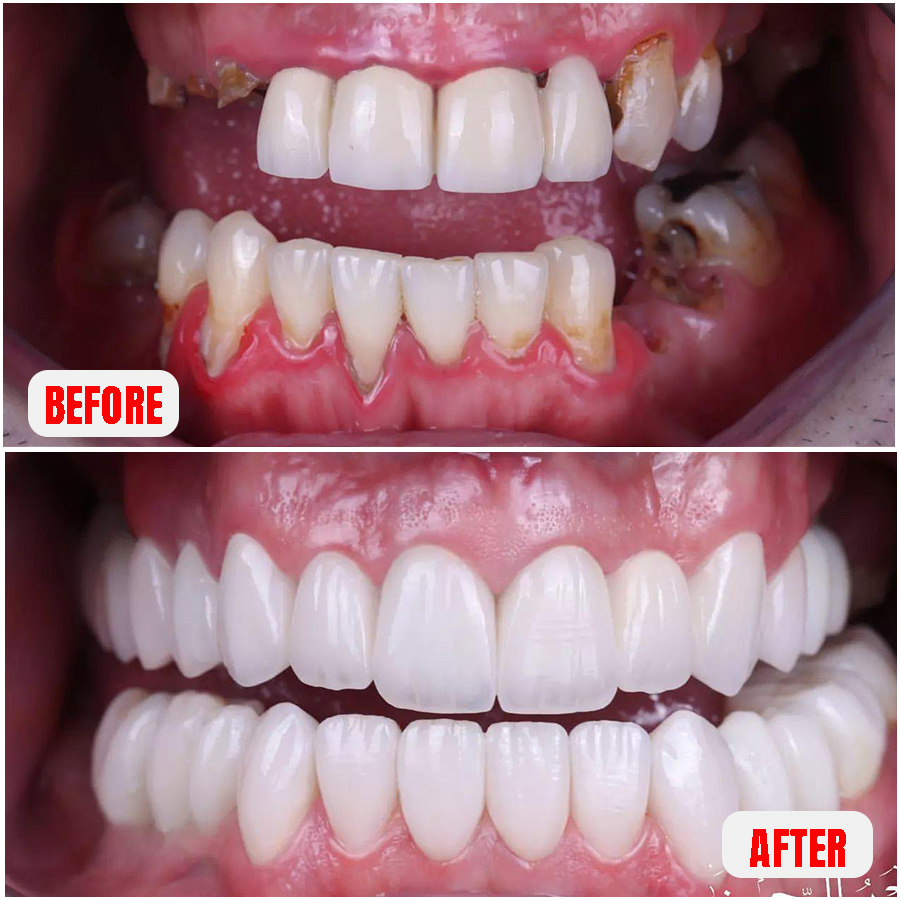 dental implant periodontal disease