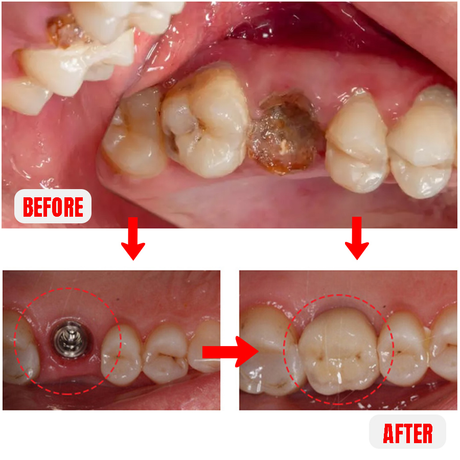 dental implant tooth decay