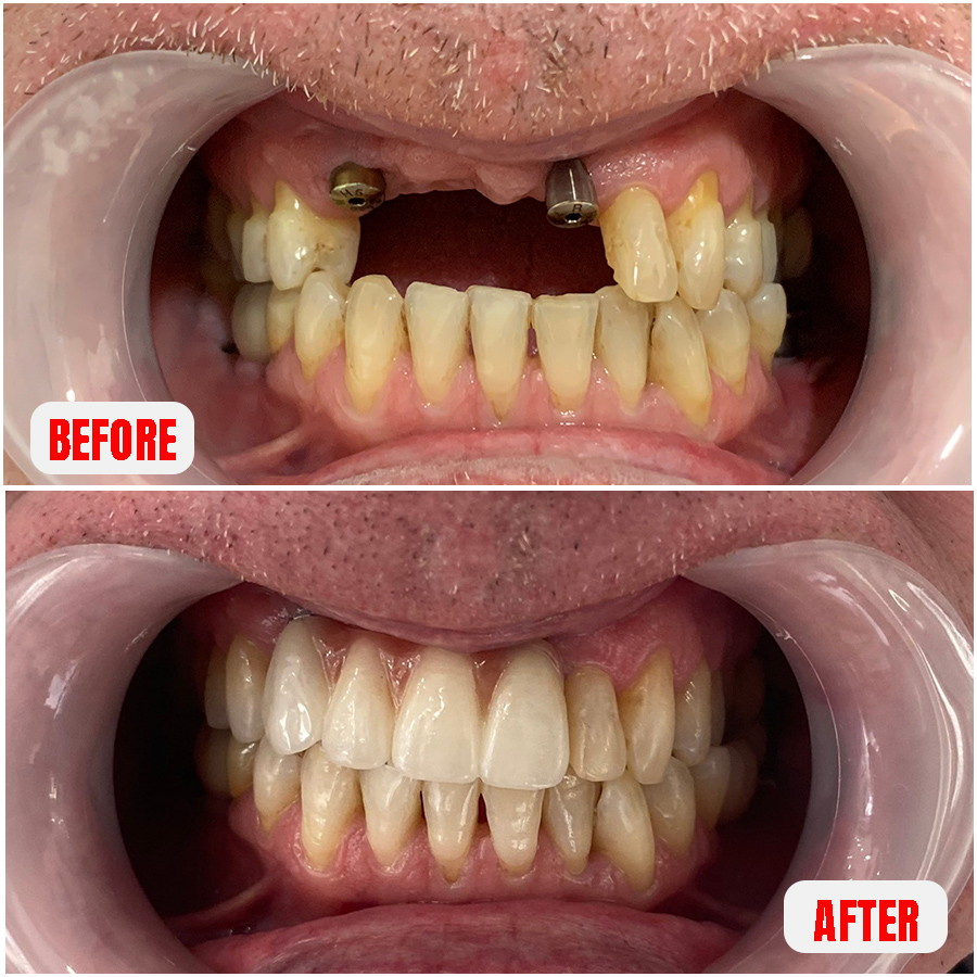 dental implant tooth loss due to trauma