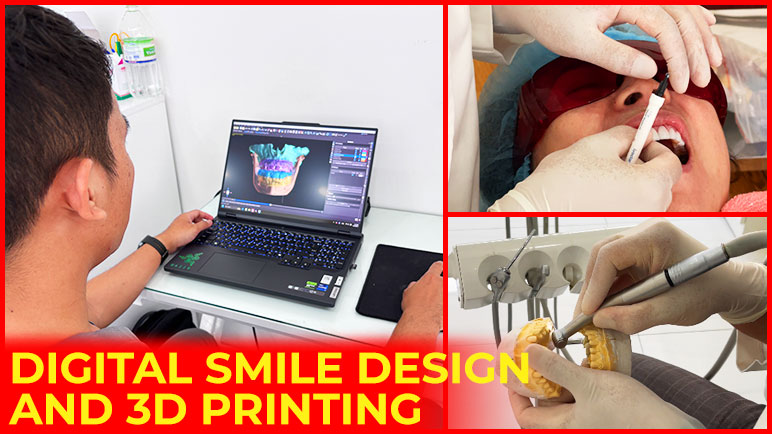 Digital smile design and 3D printing Digital smile design and 3D printing