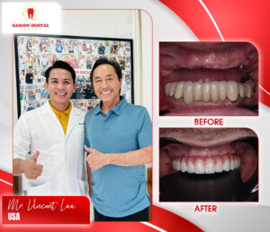 before after dental implant 1