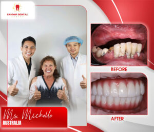 before after dental implant 10