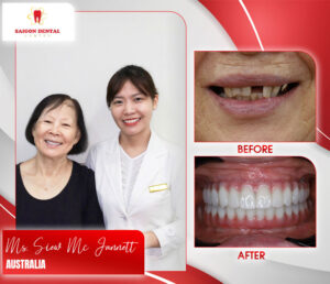 before after dental implant 11