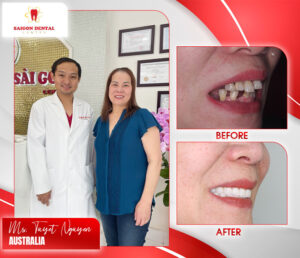 before after dental implant 2