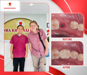 before after dental implant 3