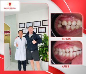 before after dental implant 4