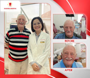 before after dental implant 6