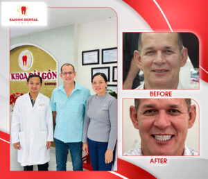 before after dental implant 7