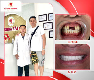before after dental implant 8