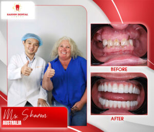 before after dental implant 9