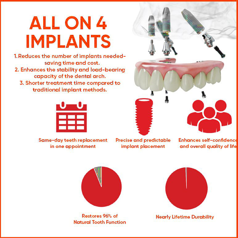 benefit of all on 4 implants benefit of all on 4 implants