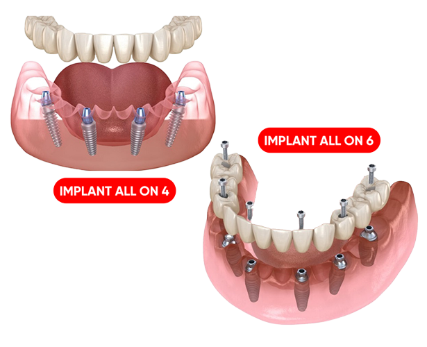 cay implant all on 4 all on 6