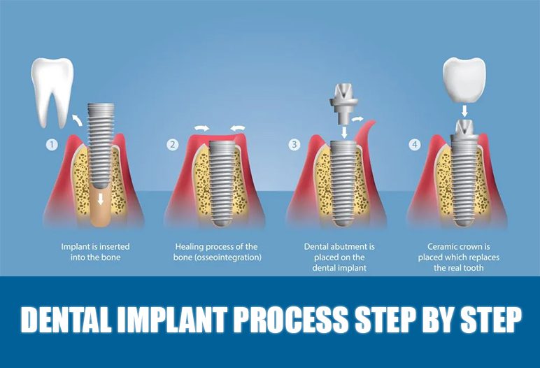 dental implant process step by step dental implant process step by step