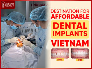 Affordable Dental Implants Vietnam