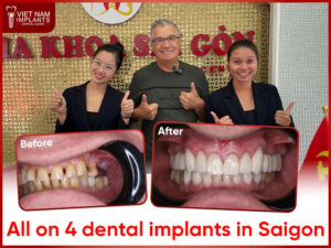 All on 4 dental implants Saigon