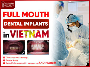 full mouth dental implants Vietnam