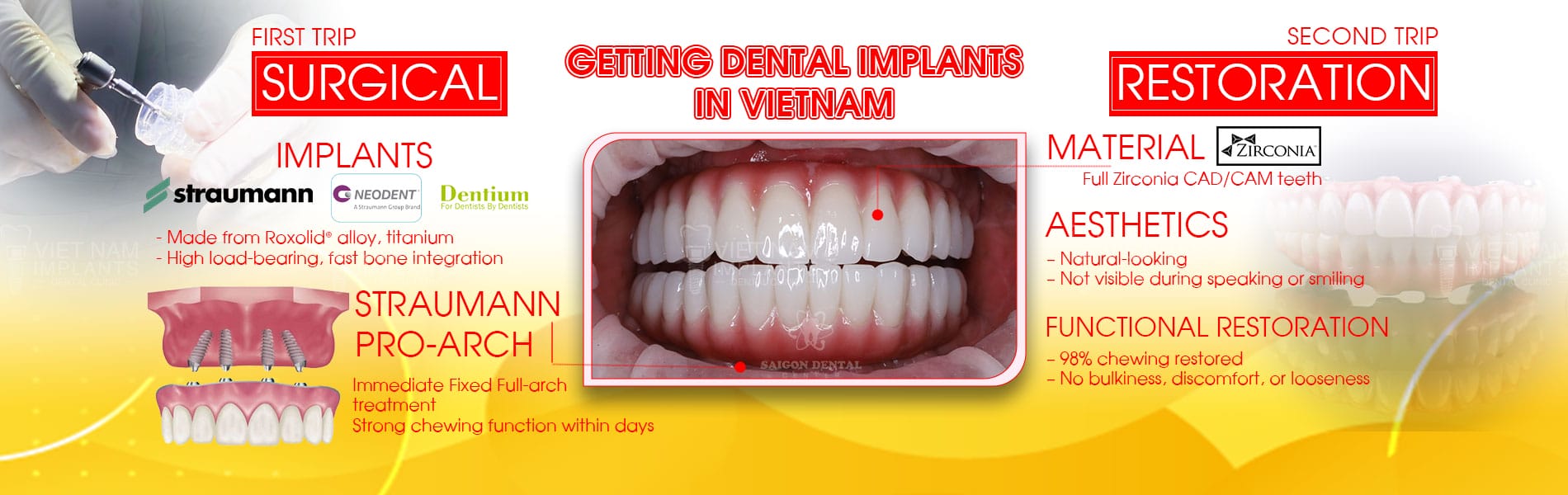 getting dental implant in vietnam